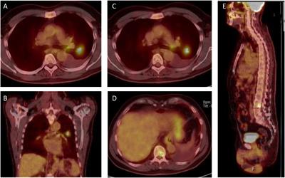 Case Report: Durable therapy response to Osimertinib in rare EGFR Exon 18 mutated NSCLC